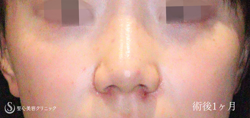 小鼻縮小_After