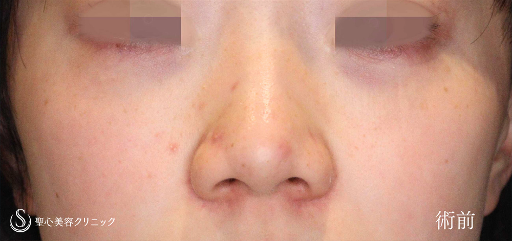 小鼻縮小_Before
