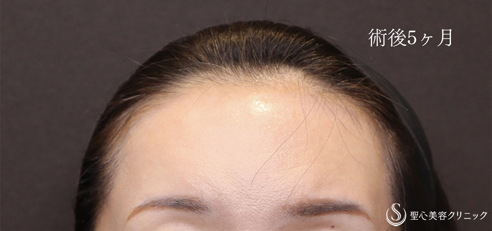 プレミアムPRP皮膚再生療法_After