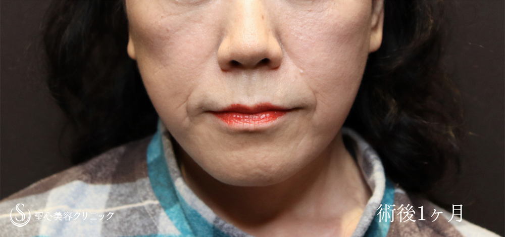 フェイスリフト_After