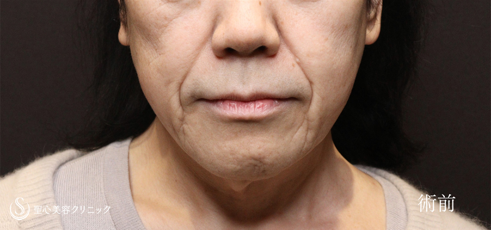 フェイスリフト_Before
