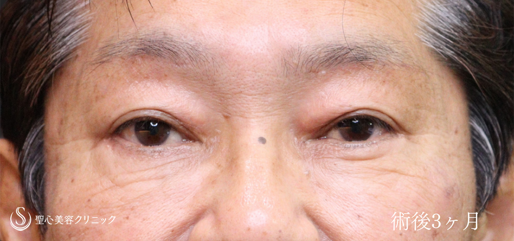 下眼瞼切開術/下眼瞼除皺術/ハムラ法＋眉下切開法（眉下リフト）_After