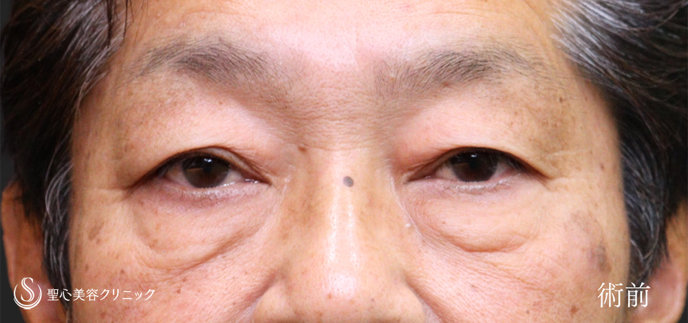 下眼瞼切開術/下眼瞼除皺術/ハムラ法＋眉下切開法（眉下リフト）_Before