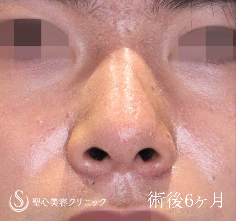 鼻尖形成（耳介軟骨移植）＋鼻尖縮小_After