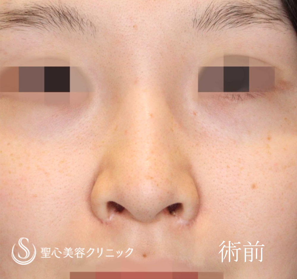 小鼻縮小_Before