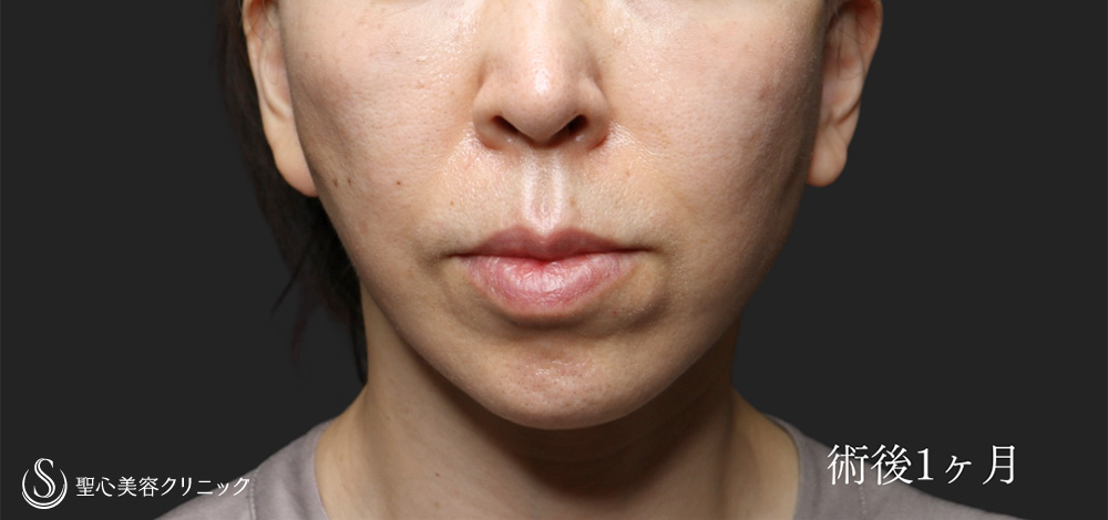 フェイスリフト_After