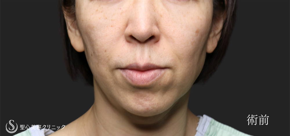 フェイスリフト_Before