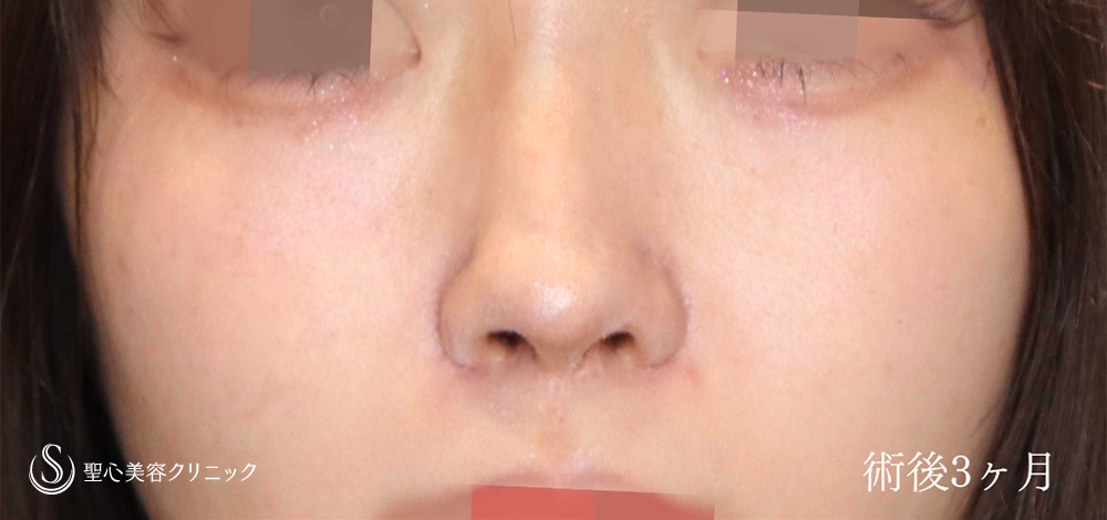 鼻孔縁下降術_After