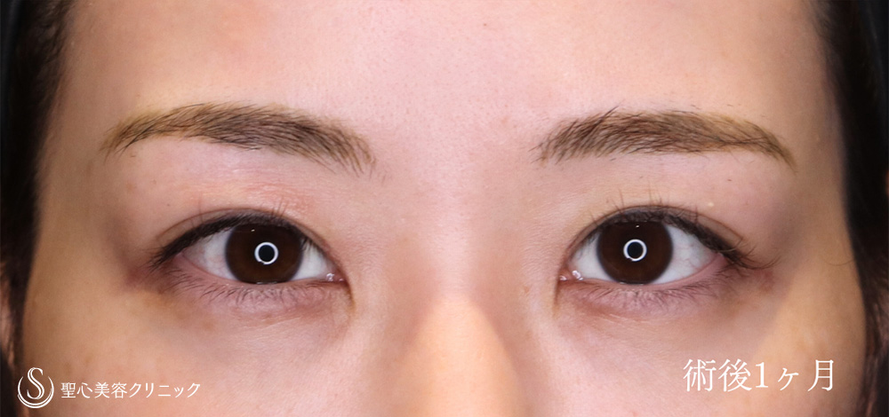 目頭切開/目上切開_After