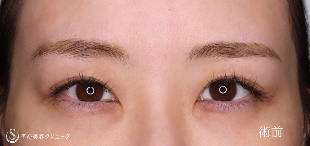 目頭切開/目上切開_Before