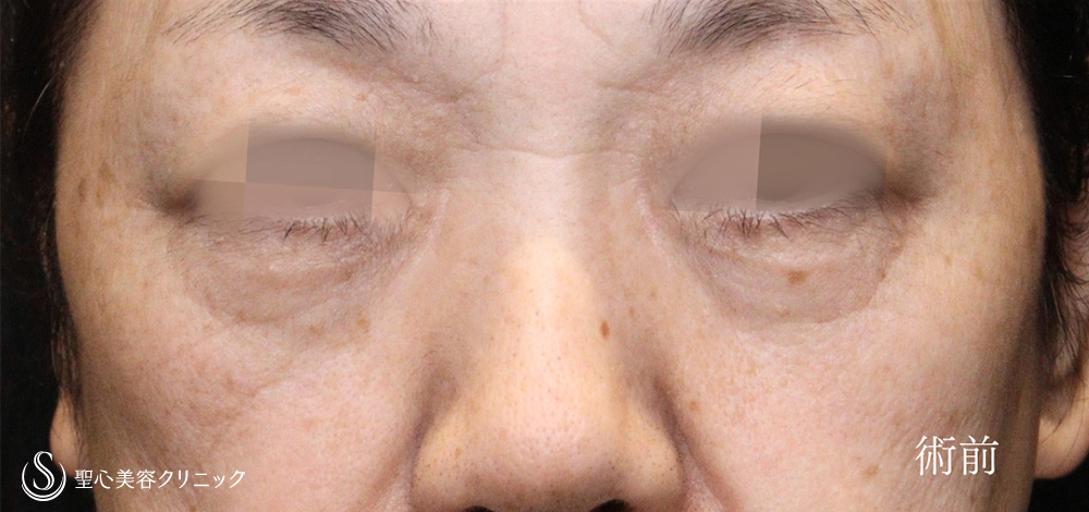 下眼瞼切開術/下眼瞼除皺術/ハムラ法_Before
