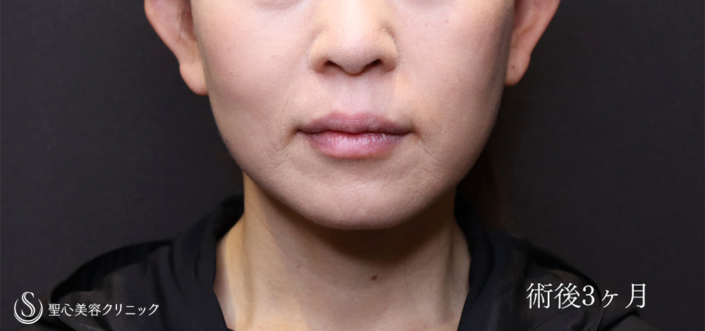 フェイスリフト_After