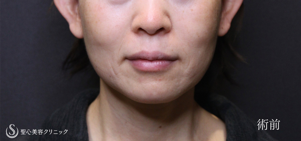 フェイスリフト_Before
