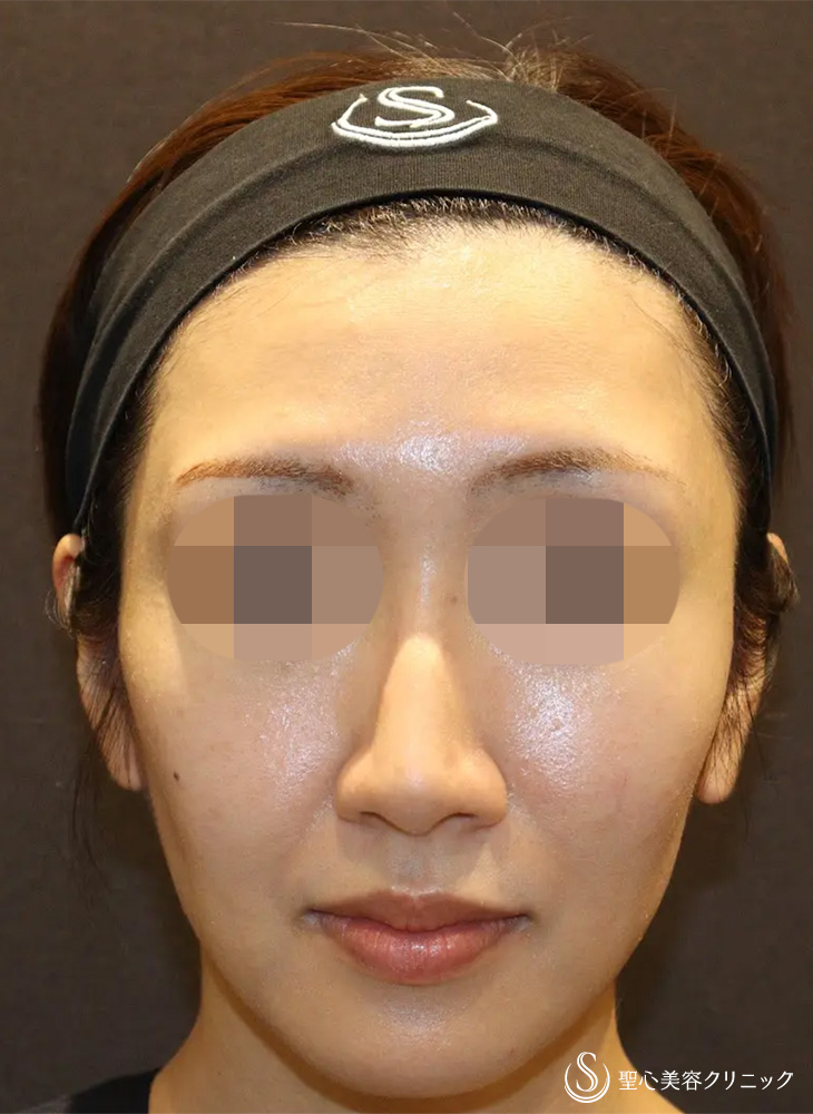 ヒアルロン酸注入（こめかみ）_After