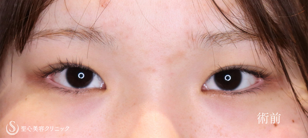 二重術（埋没法）：マイクロメソッド+α＋目頭切開/目上切開_Before