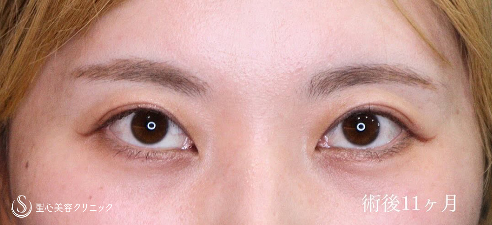 二重術（切開法）部分切開/全切開_After