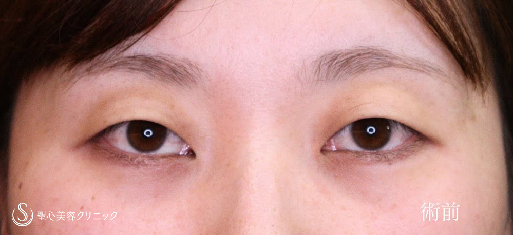 二重術（切開法）部分切開/全切開_Before