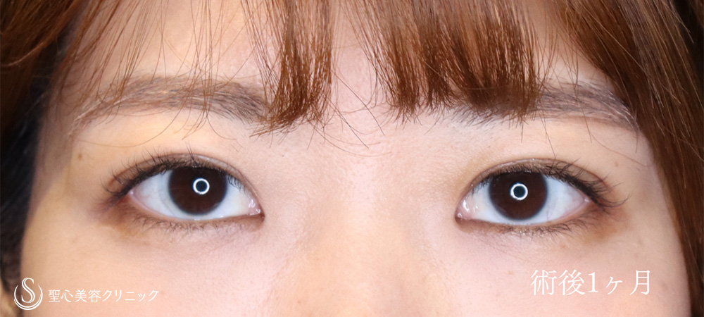 二重術（埋没法）：マイクロメソッド+α_After