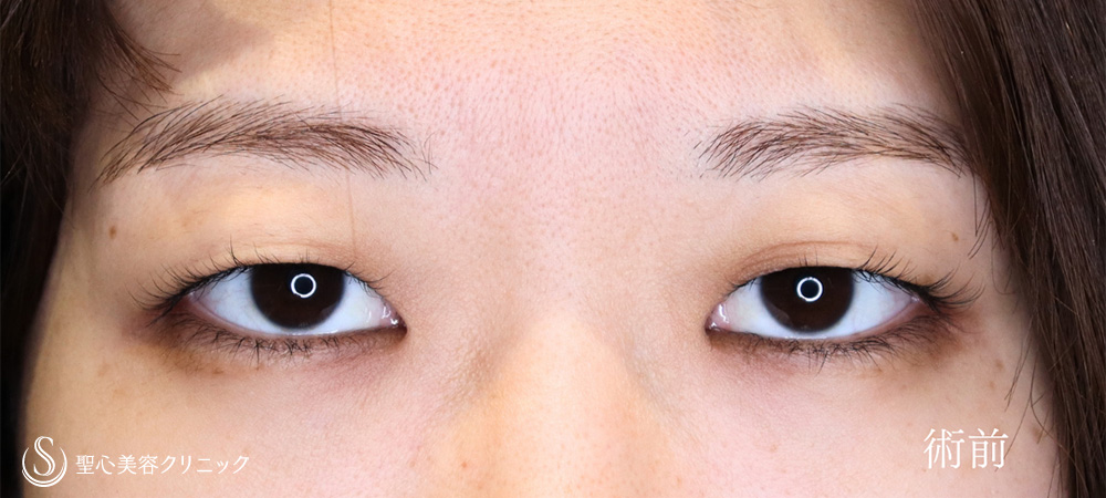 二重術（埋没法）：マイクロメソッド+α_Before