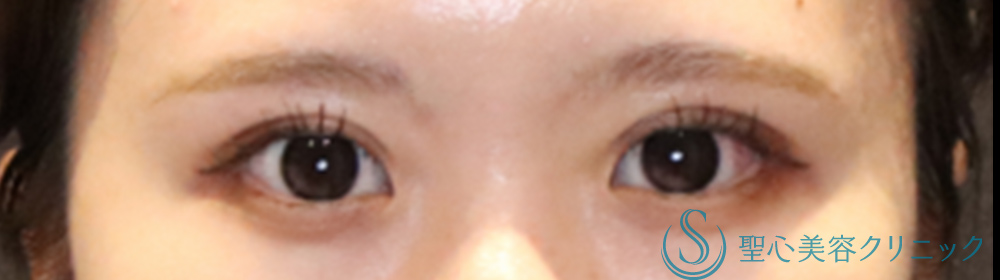 マイクロメソッド＋α（二重埋没法）_After