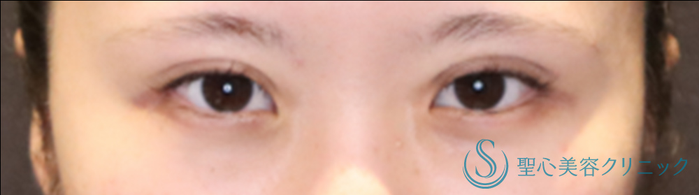 マイクロメソッド＋α（二重埋没法）_Before