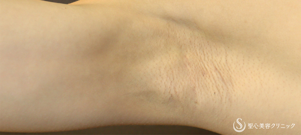 ミラドライ_After