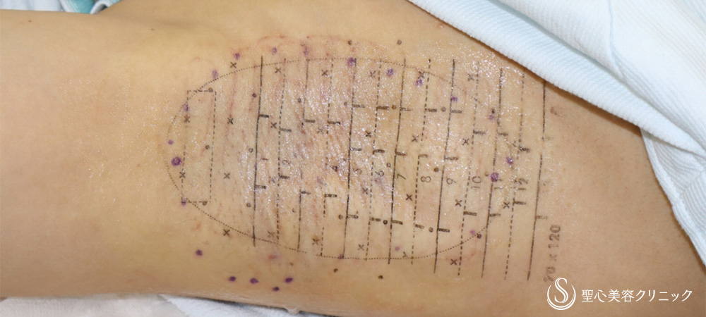 ミラドライ_Before