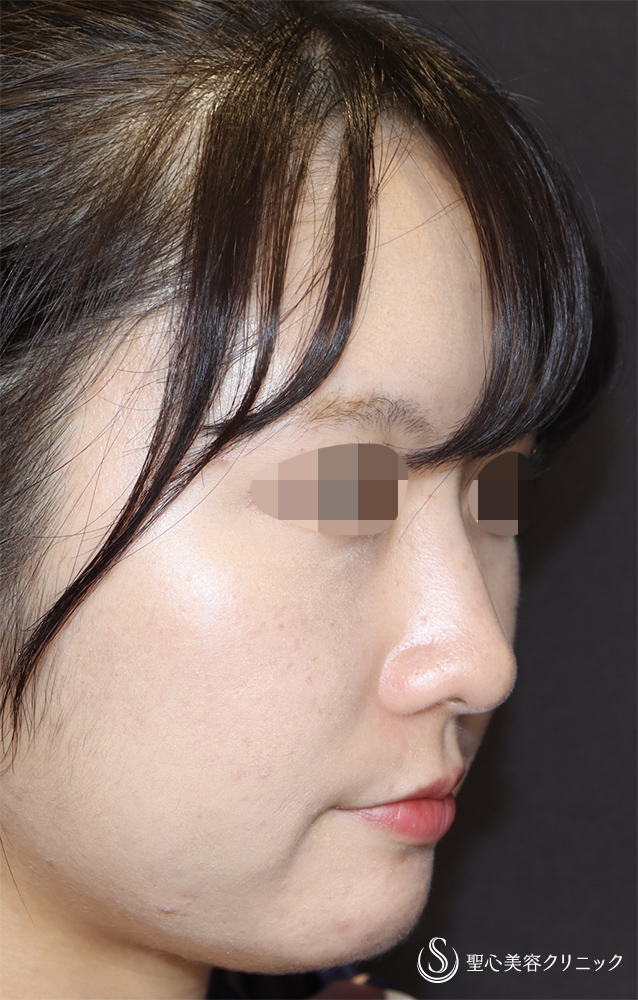 ヒアルロン酸注入（鼻）_After