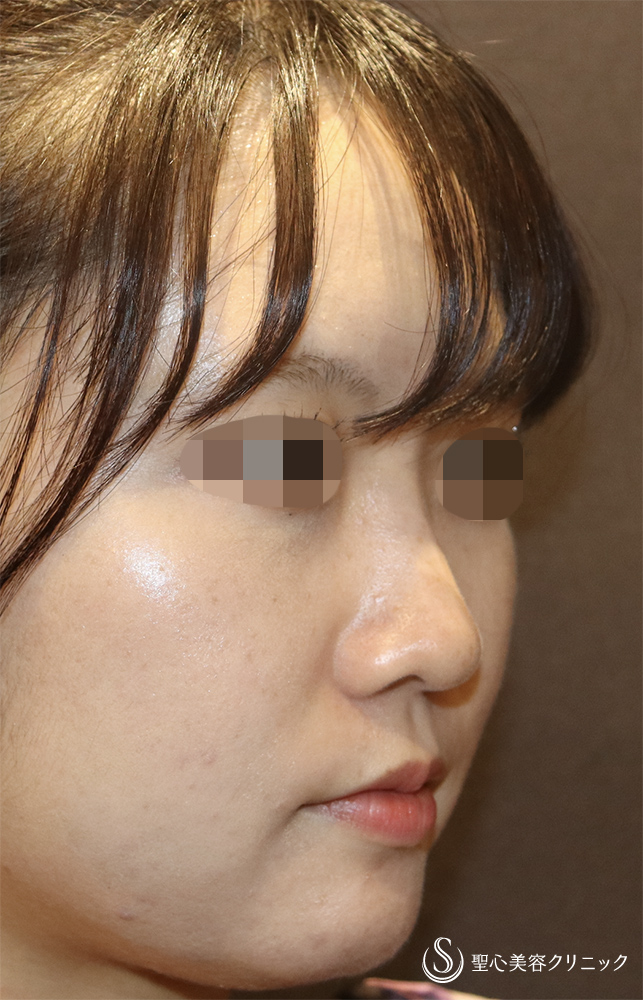 ヒアルロン酸注入（鼻）_Before