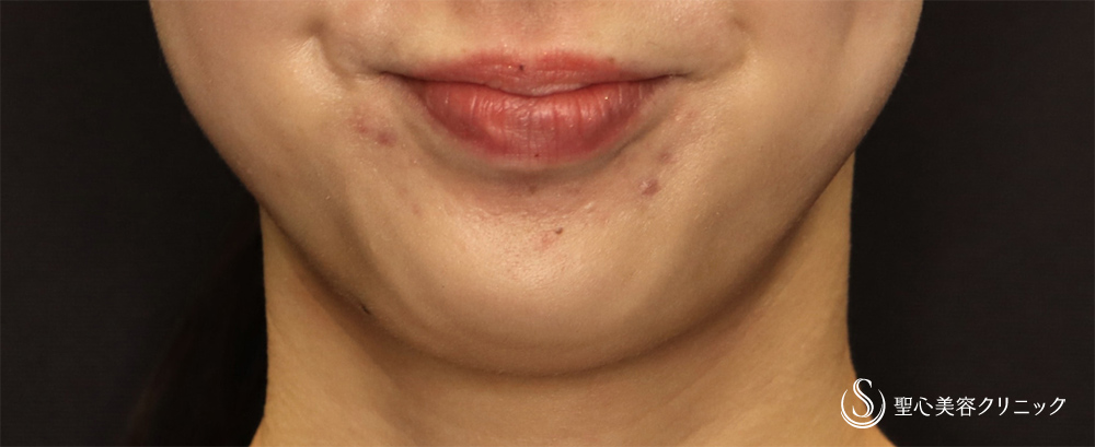 ボトックス注入_After