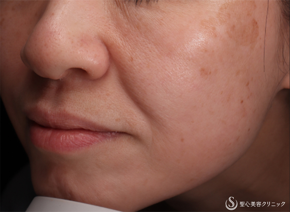 プレミアムPICO肌再生療法_Before