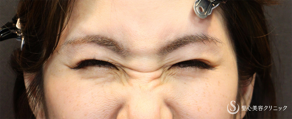 ボトックス注入_Before