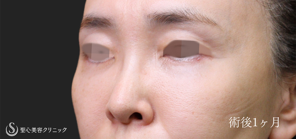 ハムラ法＋ミッドチークリフト_After