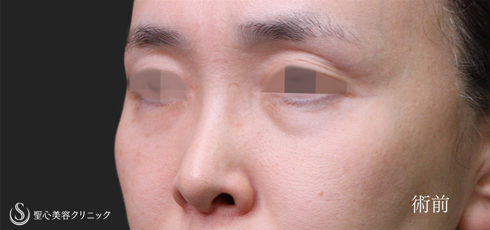 ハムラ法＋ミッドチークリフト_Before