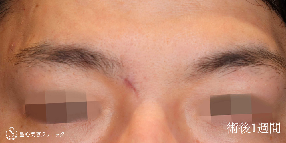 ホクロ除去（切除法）_After