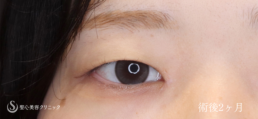 目頭切開/目上切開_After