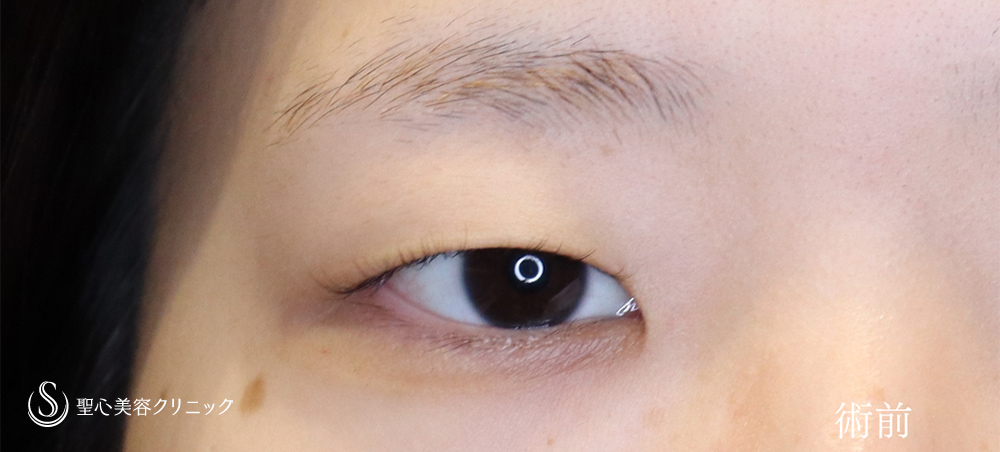 目頭切開/目上切開_Before