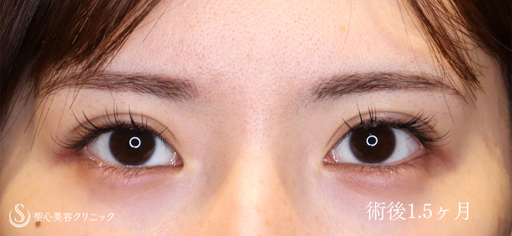 二重術（埋没法）：マイクロメソッド+α_After