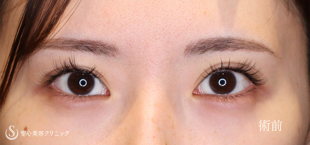 二重術（埋没法）：マイクロメソッド+α_Before